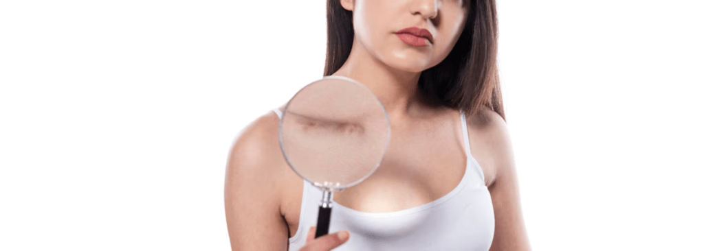 Burn, Scars & Keloids