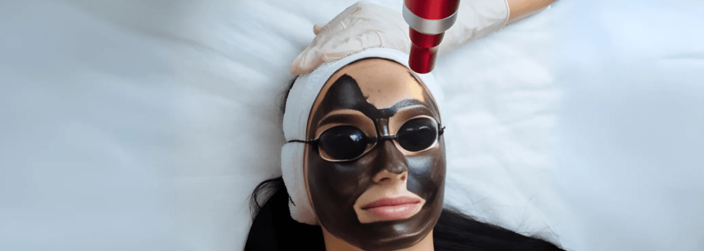 Laser Toning (Carbon Facial)