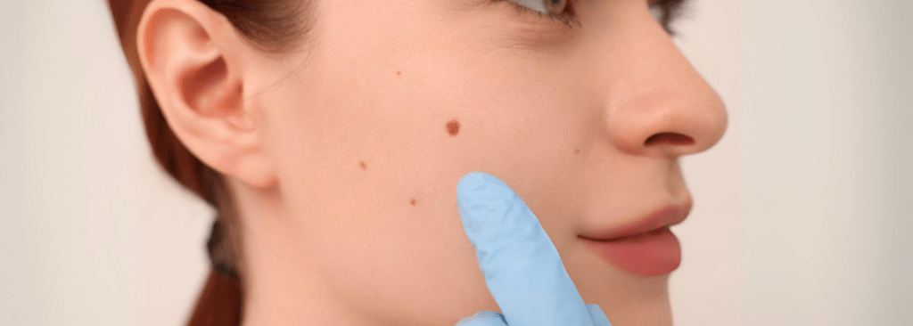 Moles & Birthmarks