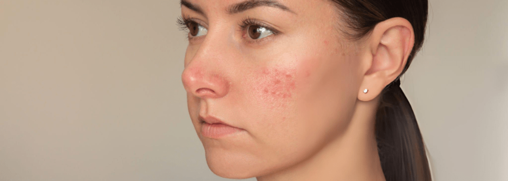 Sensitive Skin & Rosacea