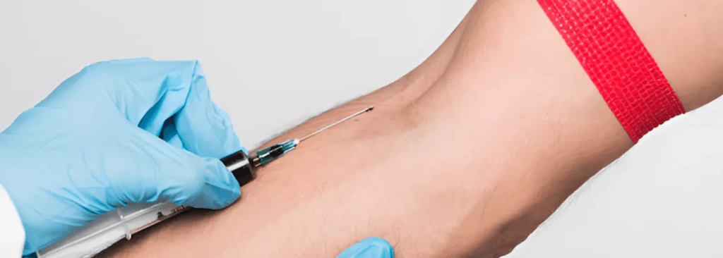 Varicose Veins Treatments