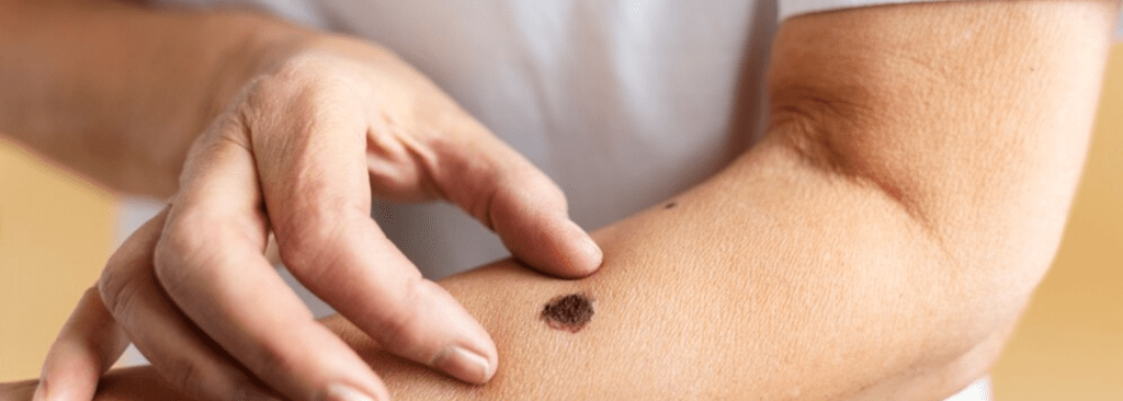 Warts & Skin Tags